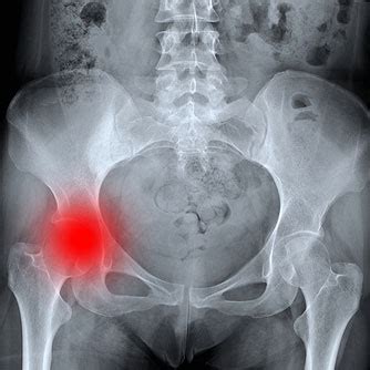 Sep 11, 2019 · the studies also revealed a couple of downsides to high levels of calcium supplementation, but not to calcium obtained through a regular diet: Calcium Plus Vitamin D Helps to Reduce Hip Fracture Risk ...