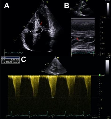 How Tomeasure Intraventricular Obstruction In Hypertrophic Cardiomyopathy