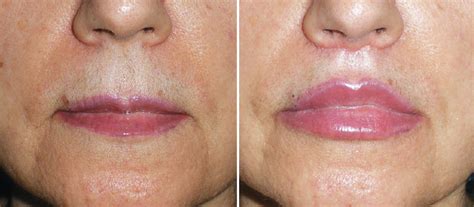 Lip Lifts A Procedure To Consider Practical Dermatology