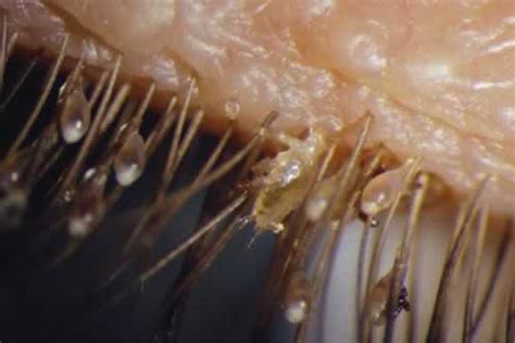 Pubic Lice Phthirius Pubis In Action Parasites Photo Fanpop