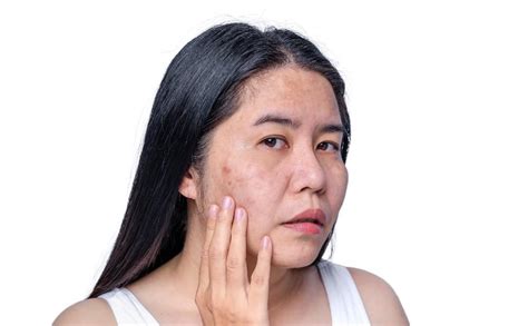 Symptom Guide Menopausal Acne Zand Dermatology Dermatologists