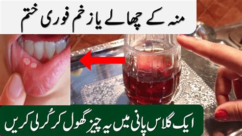 Mouth Sores Causes Symptoms And Treatment Everything You Need To Know