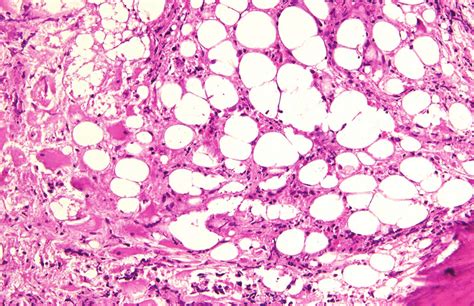 Maybe you would like to learn more about one of these? Bone marrow biopsy in high magnification showing few ...