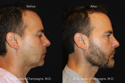 Custom Chin And Jaw Implants — Plastic Surgeon Beverly Hills Ca Dr