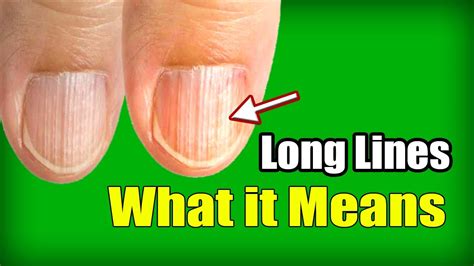 Lines On Your Fingernails Indicate Underlying Issues What Are They