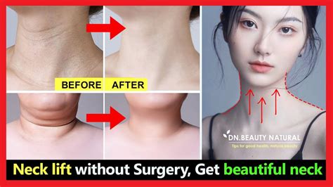 Neck Lift Without Surgery Get Rid Of Tech Neck Lines Lose Neck Fat Fix Saggy Neck And Turkey