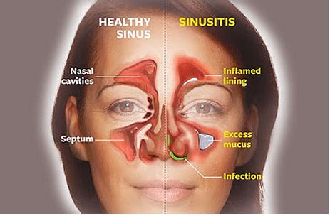 No More Allergies, Asthma, Or Sinus Infections