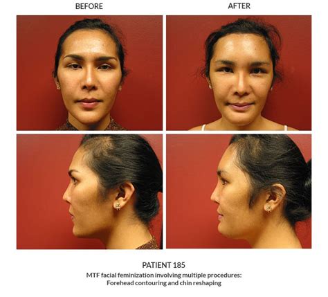 MTF Facial Feminization Post Op Keelee MacPhee M D