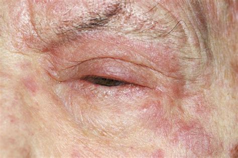 Pictures Of Shingles On Your Face Itiscouragethatcounts