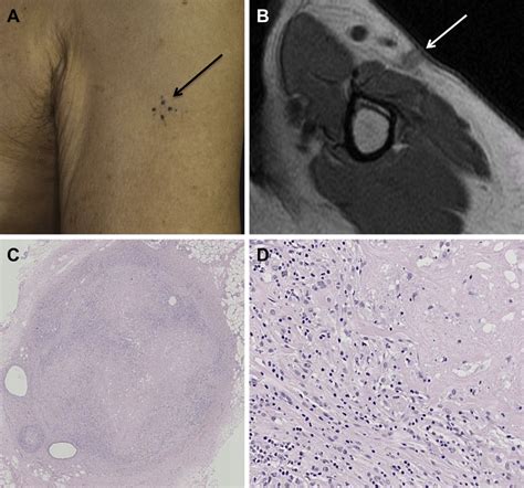 A Clinical Appearance Of The Subcutaneous Nodule In The Patients