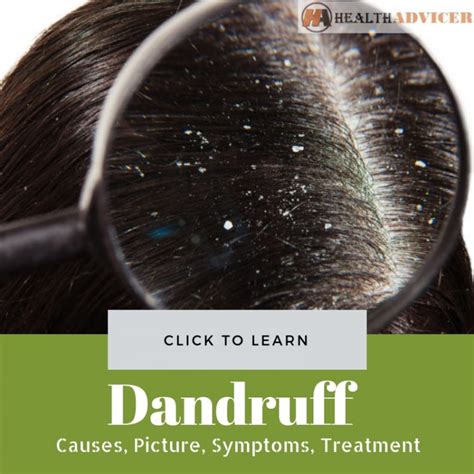 Dandruff Causes Picture Symptoms And Treatment