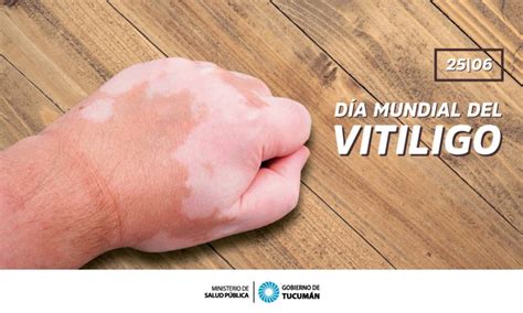 25 De Junio Día Mundial Del Vitiligo Ministerio De Salud Pública De