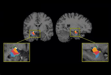 Anxiety Drives Amygdala Differences In Autistic Youth Spectrum