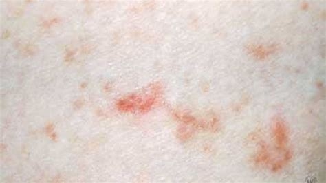 What You Need To Know About Scabies Wkef