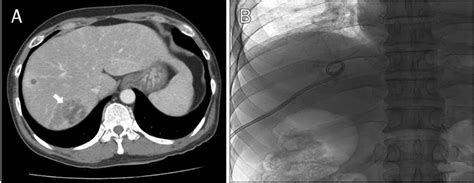 A Initial Abdominal Ct Scan Shows Multiple Liver Abscesses With The