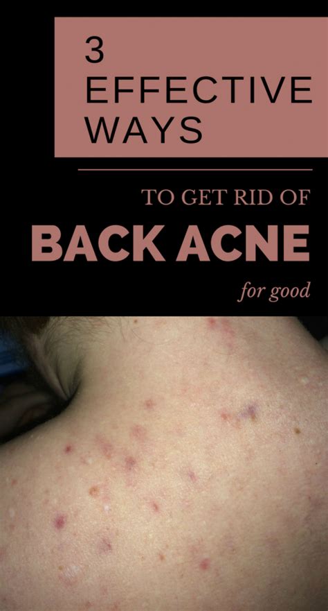 3 Effective Ways To Get Rid Of Back Acne For Good Back Acne Treatment