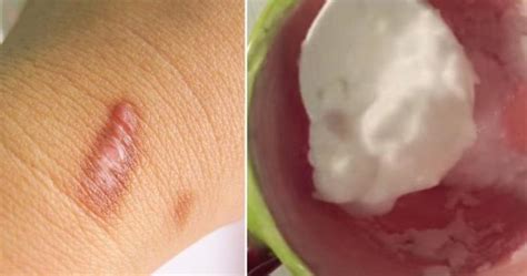 Remove Keloids With These 10 Natural Remedies David Avocado Wolfe
