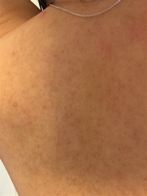 Skin Concerns Any Ideas What These Dark Spots Are On My Back