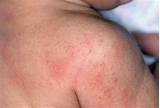 What Is The Best Treatment For Heat Rash Pictures