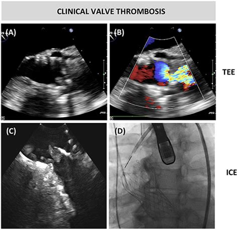 Frontiers Clinical Valve Thrombosis And Subclinical Leaflet