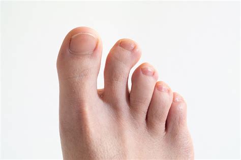 Right Caucasian Male Foot Top View With Bent Crooked Toe Against Bright