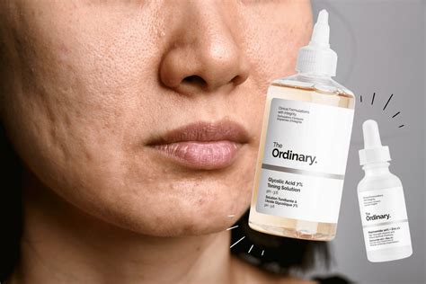 Best 4 The Ordinary Products For Acne Scars You Should Try Now Myeppo