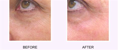 Softer Smoother And Healthier Skin With Photo Rejuvenation