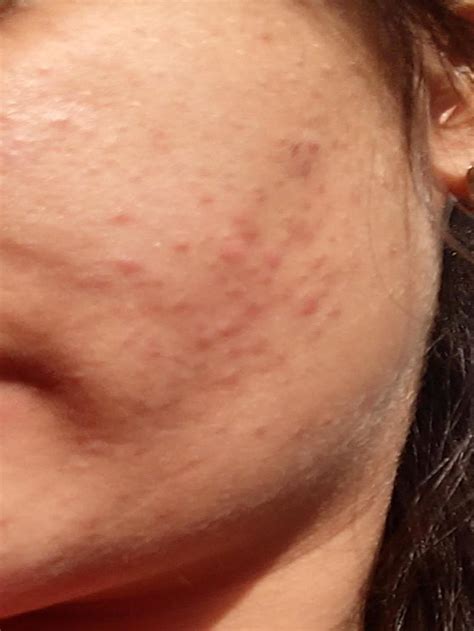 Erythematous Papules On The Left Cheek With No Complaints Of Itching