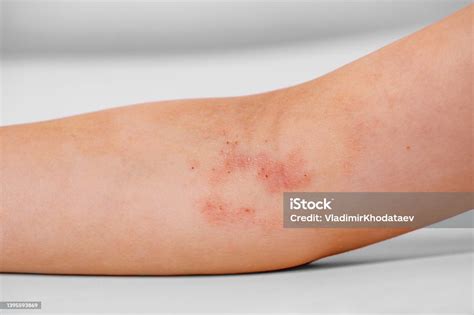 Atopic Dermatitis On The Childs Arm Stock Photo Download Image Now