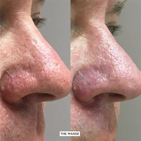 Broken Capillaries Removal In Sydney The Manse Clinic