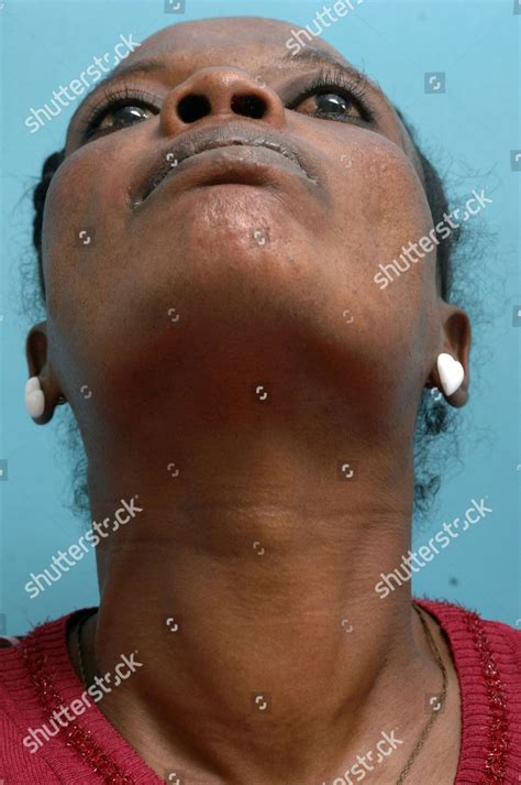 Middleaged Woman Suffering Small Toxic Goitre Editorial Stock Photo