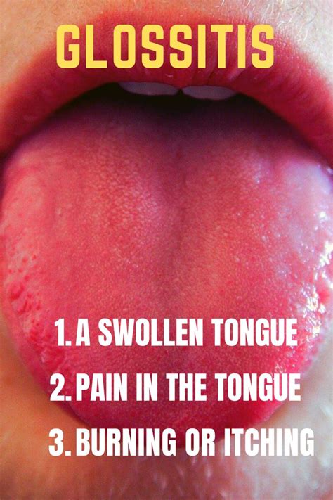 Tongue Tongue Disease Tongue Disorder Glossitis Swollen Tongue Health Healthy