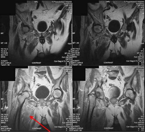 Iliopsoas Tuberculous Abscess Associated With Cervical And Axillary