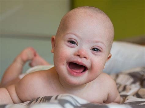 People with down's syndrome may be more likely to have other health conditions, such as heart conditions, and problems with the digestive sadly, most babies with edwards' syndrome or patau's syndrome will die before or shortly after birth. This State is Working to Protect Down Syndrome Children ...
