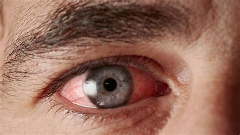 Wenn die augen jucken, ist das zwar sehr unangenehm, aber meist harmlos. So könnt ihr mit Kokosöl Bindehautentzündung lindern ...