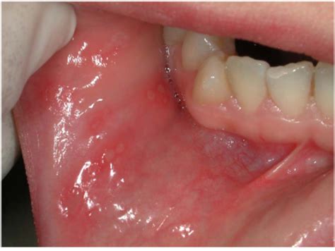 A large patch, grayish opaque that may be present along the buccal mucosa. Several RAS on buccal mucosa in a CD patient. | Open-i