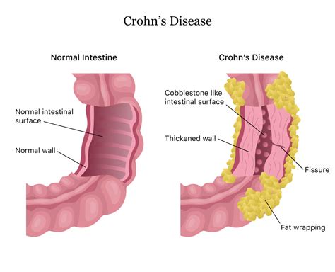 New Trial Offers Hope For Crohn’s Disease Patients