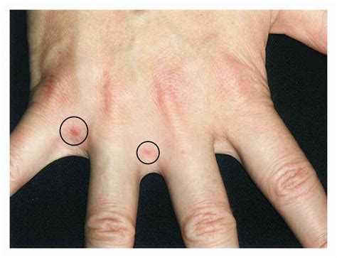 Pruritus And Papular Lesions Between Fingers Axillae Groin And