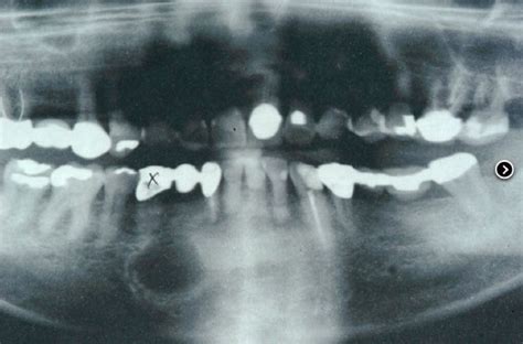 Lower Jaw Cyst Lower Jaw Cyst Kazemi Oral Surgery