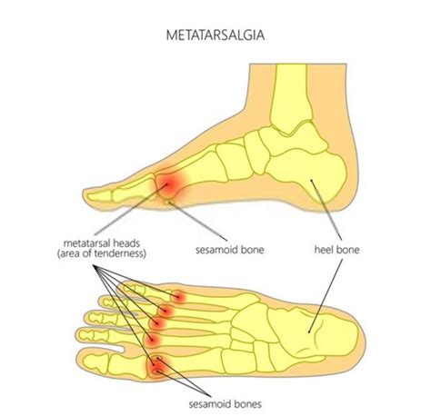 Foot Problems Tips For Metatarsalgia Treatment Hoodmwr