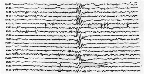 Clinical And Eeg Characteristics Of Benign Rolandic Epilepsy In Chinese