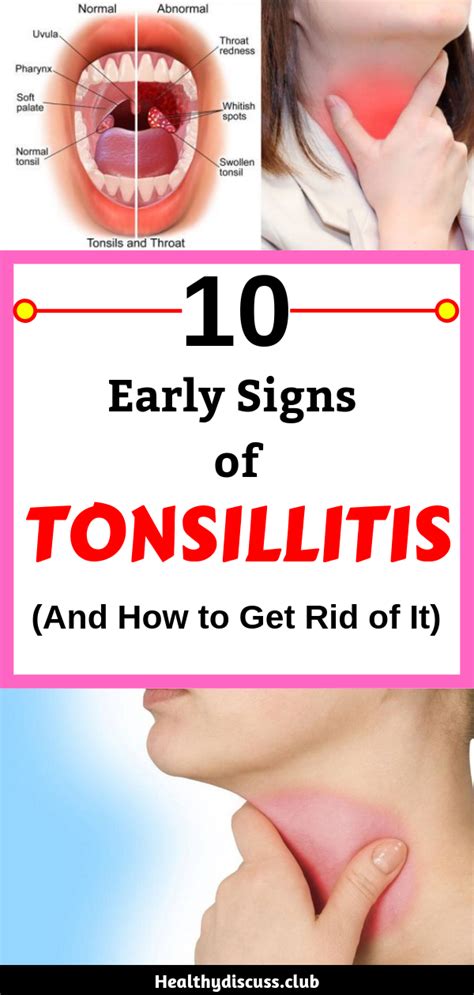 Bacterial Tonsillitis Symptoms In Adults