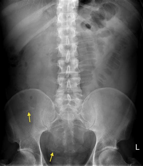 Small Bowel Obstruction Radiology At St Vincents University Hospital