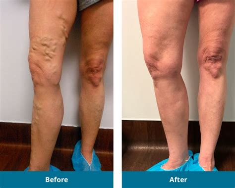 Before And After Gallery Indiana Vein Specialists