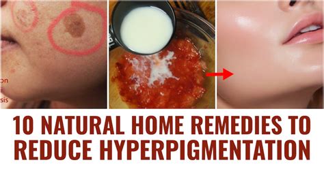 10 Natural Home Remedies To Treat Hyperpigmentation