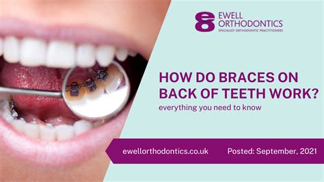 How Do Braces On Back Of Teeth Work Ewell Orthodontics