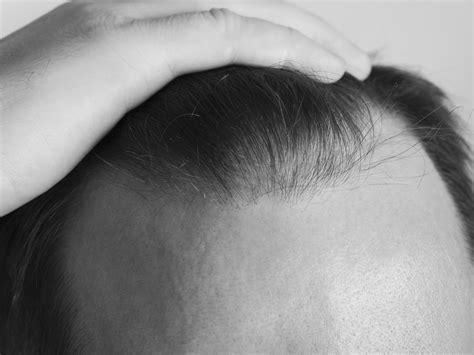 Answered Can Hair Grow Back After Thinning Sons Uk