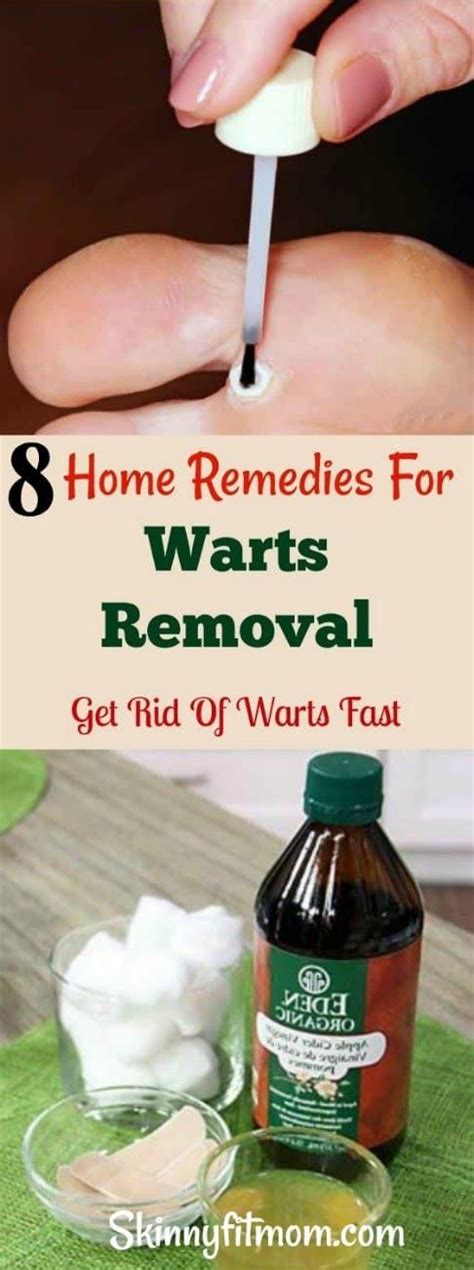 8 Home Remedies For Warts Removal Fast Easily And Naturally Warts