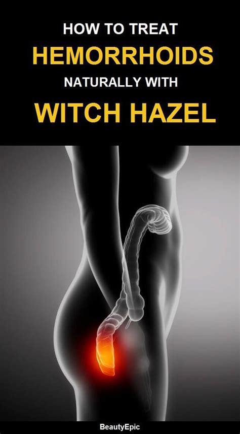 How To Treat Hemorrhoids With Witch Hazel
