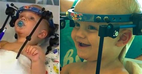 Surgeons In Australia Reattach Infants Head To His Spine After